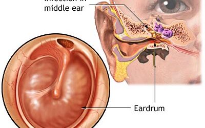 MIDDLE EAR INFECTIONS