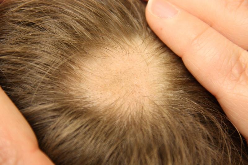 ALOPECIA AREATA