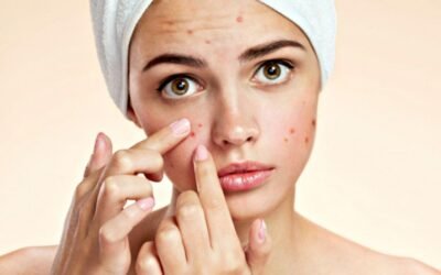 ACNE VULGARIS
