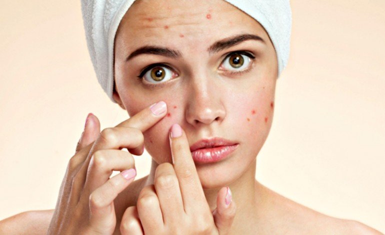 ACNE VULGARIS
