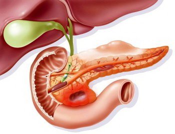 CHOLELITHIASIS (GALL STONES)