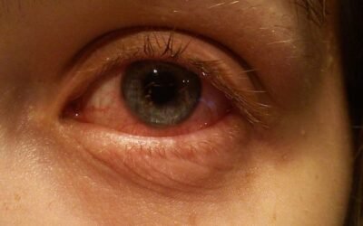 CONJUNCTIVITIS