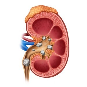 RENAL CALCUI (KIDNEY STONE)