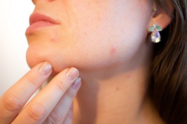 URTICARIA