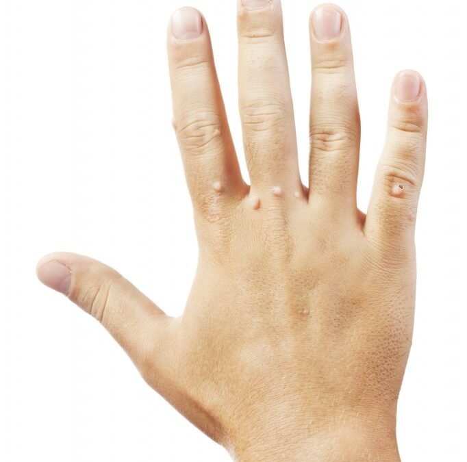 WARTS