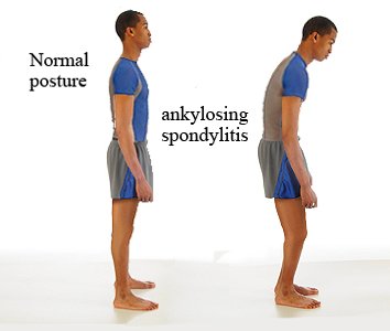 Ankylosing Spondylitis