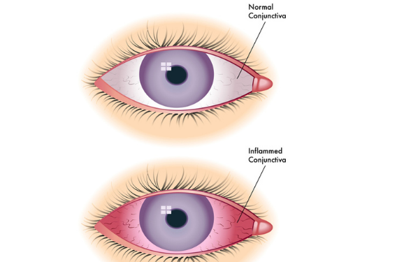 PINK EYE OR CONJUNCTIVITIS