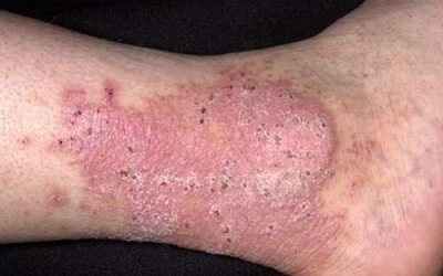 LICHEN PLANUS