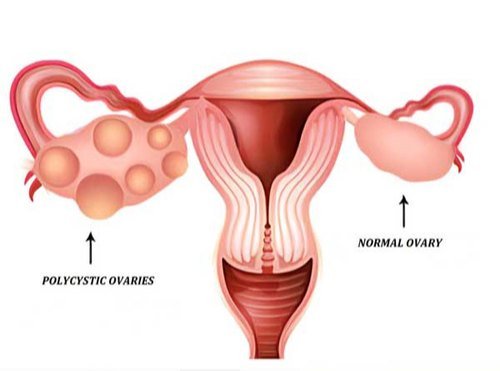 POLYCYSTIC OVARIAN SYNDROME