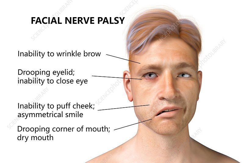 BELL’S PALSY