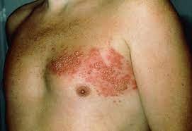 SHINGLES OR HERPES ZOSTER